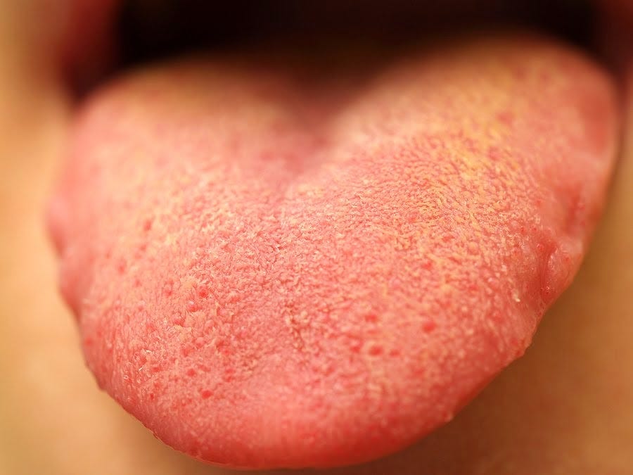how to get rid of yeast infection at home | by relationship | Medium