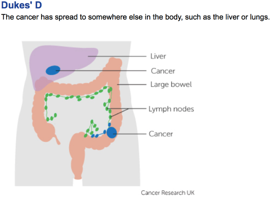 Tumor Sizes Chart Colon