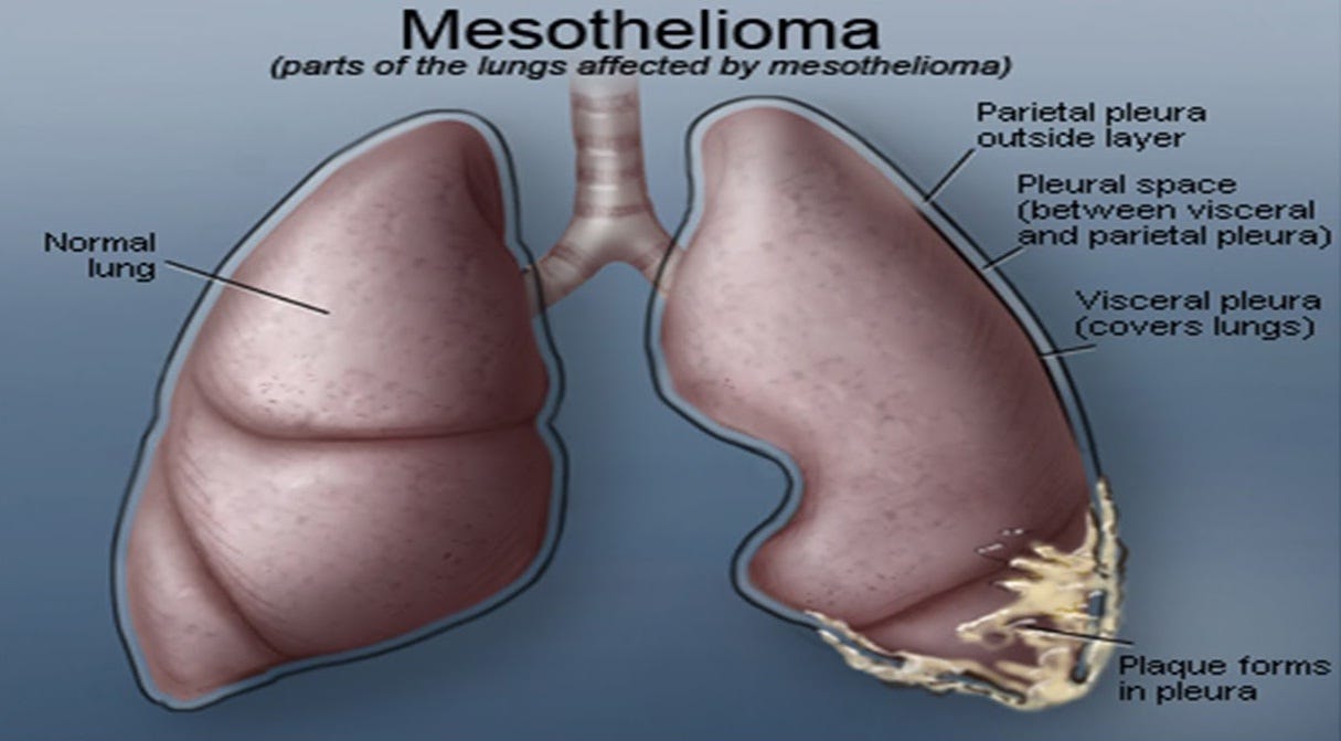 mesothelioma is caused by toxicity of
