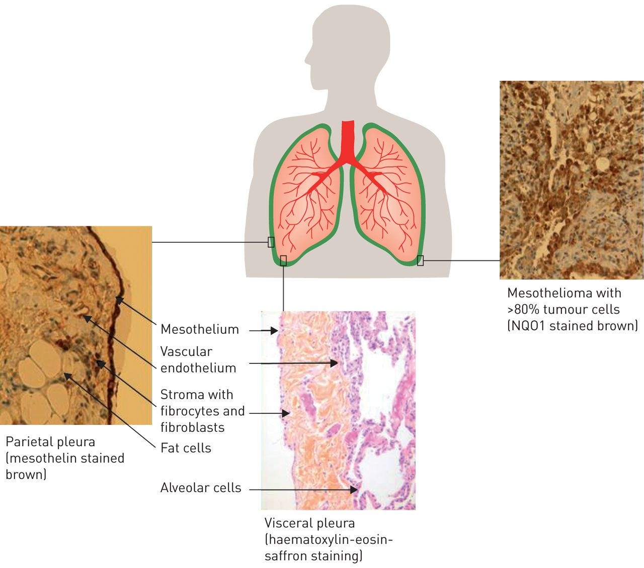 Metastasis What If Mesothelioma Spreads By Abdeslam Ait Hida Medium