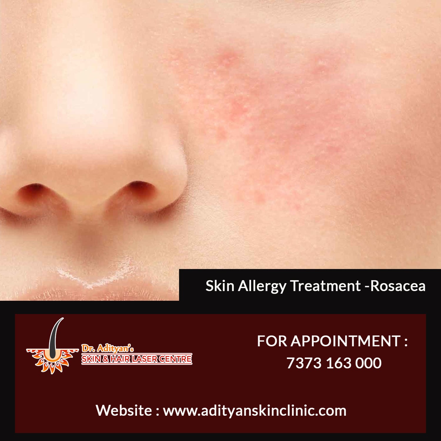 best facial treatment for rosacea