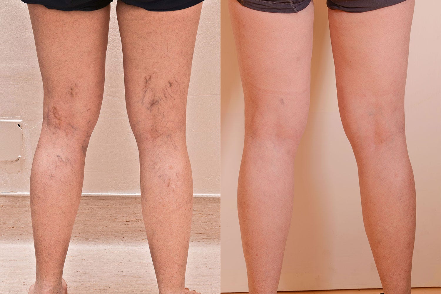 Deep Vein Thrombosis By Vein Doctor At Boston Ma By Best Vein Center Medium