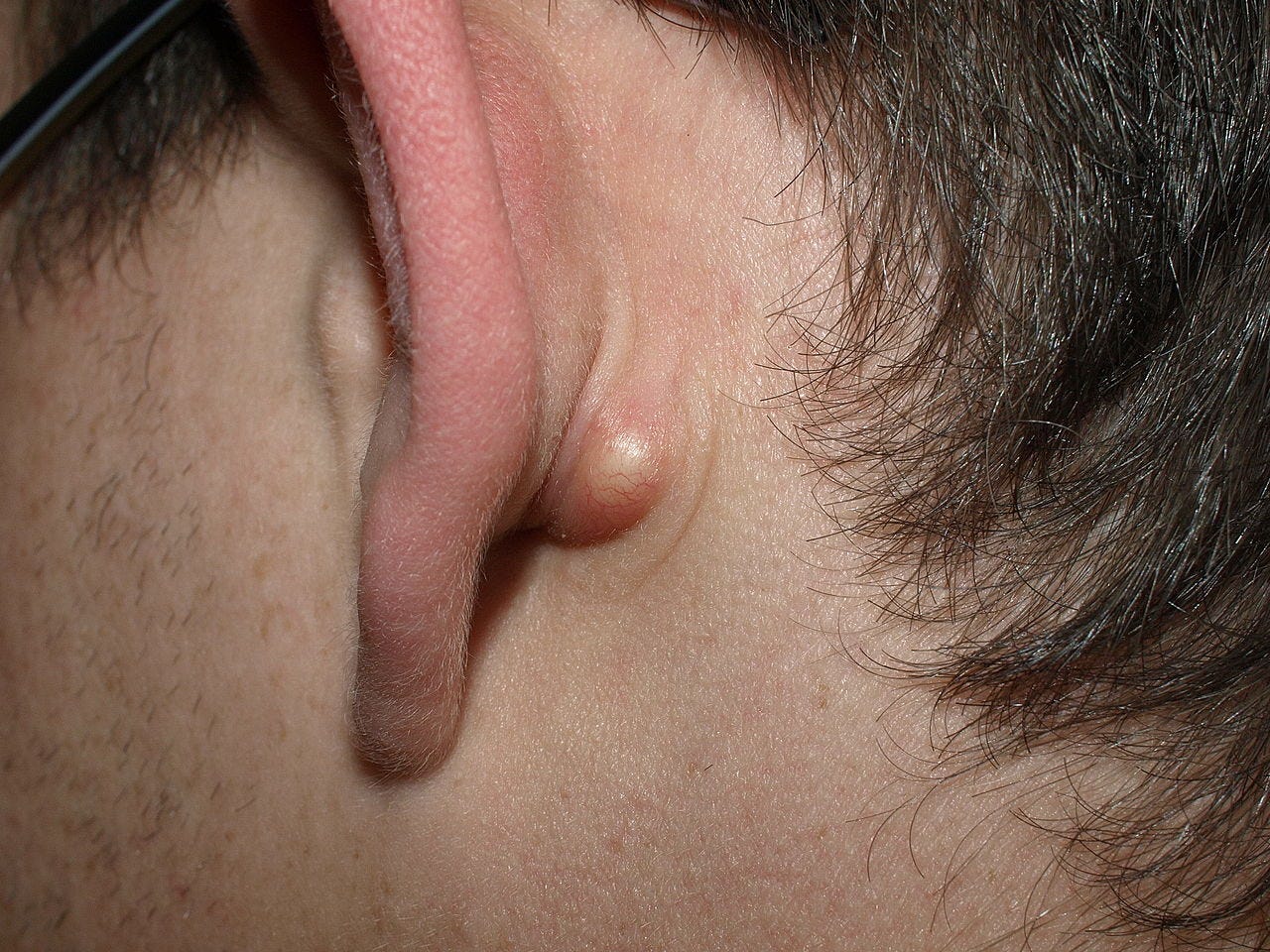get rid of cyst fast