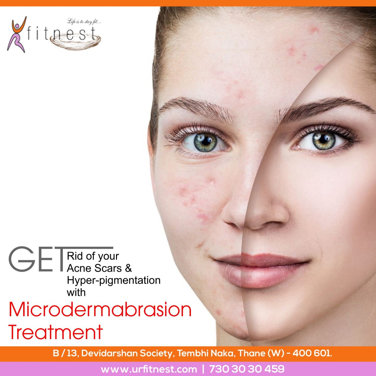 microdermabrasion treatment