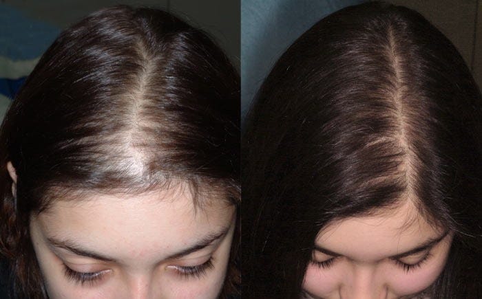 Is Hair Transplant Surgery Good For Women Eugenix Medium