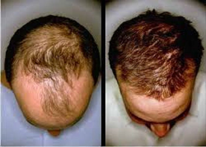 Your Hair Loss Solution Prp Hair Loss Clinic In Newport Beach
