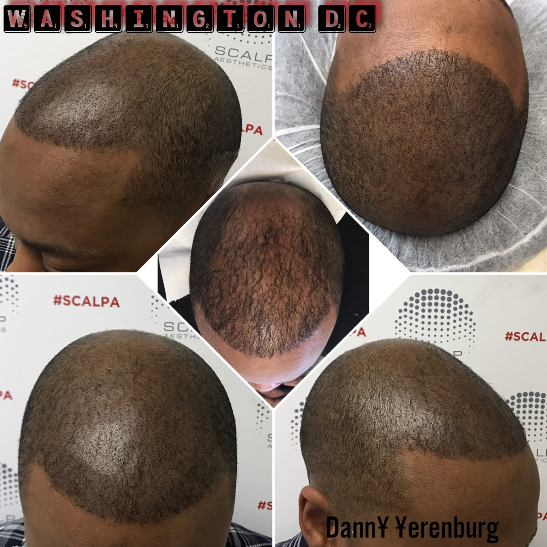 Picture Of Hair Loss Tattoo Https Www Facebook Com Scalpaesthetics By Dennis Rudolphe Medium