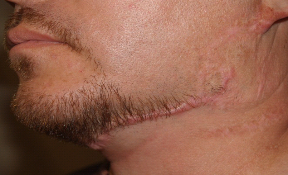 Facial hair transplant. is a procedure which restores hair to  Facial hair transplant. is a procedure which restores hair to