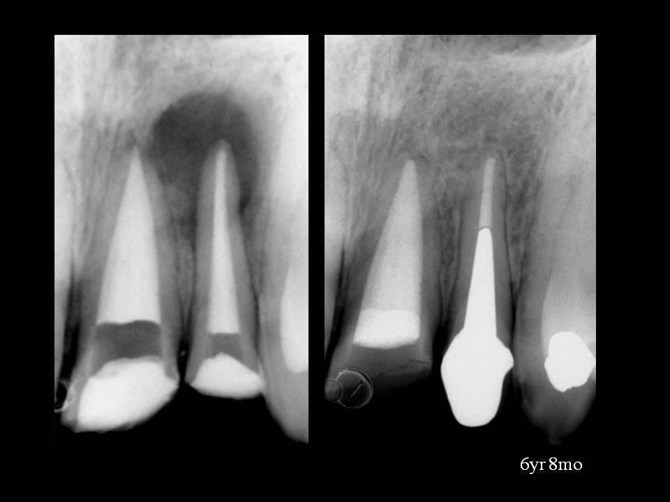 Controversial Working Length Aspects in Endodontics (Riccuci) by