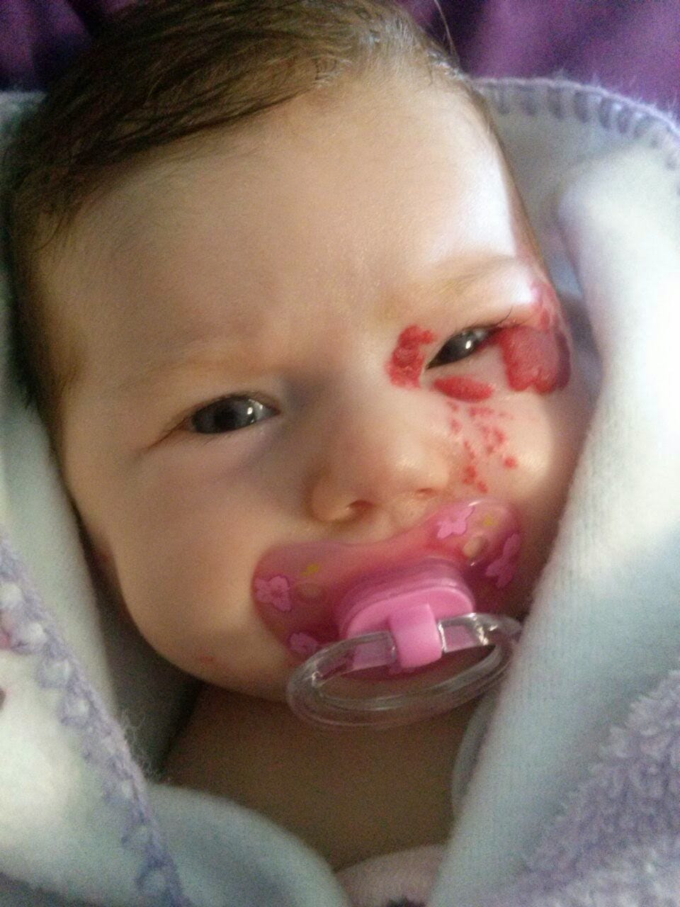 Nem Sempre E So Uma Mancha O Acumulo De Vasos Sanguineos Pode Ser By Camila Tempas Beta Redacao Medium