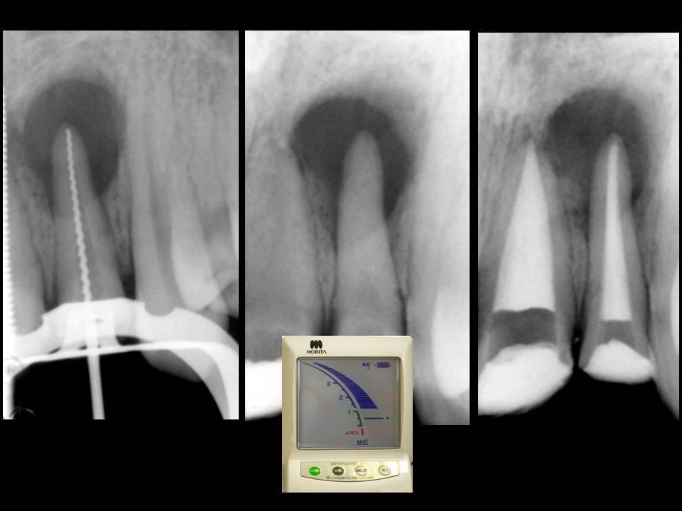 Controversial Working Length Aspects in Endodontics (Riccuci) by