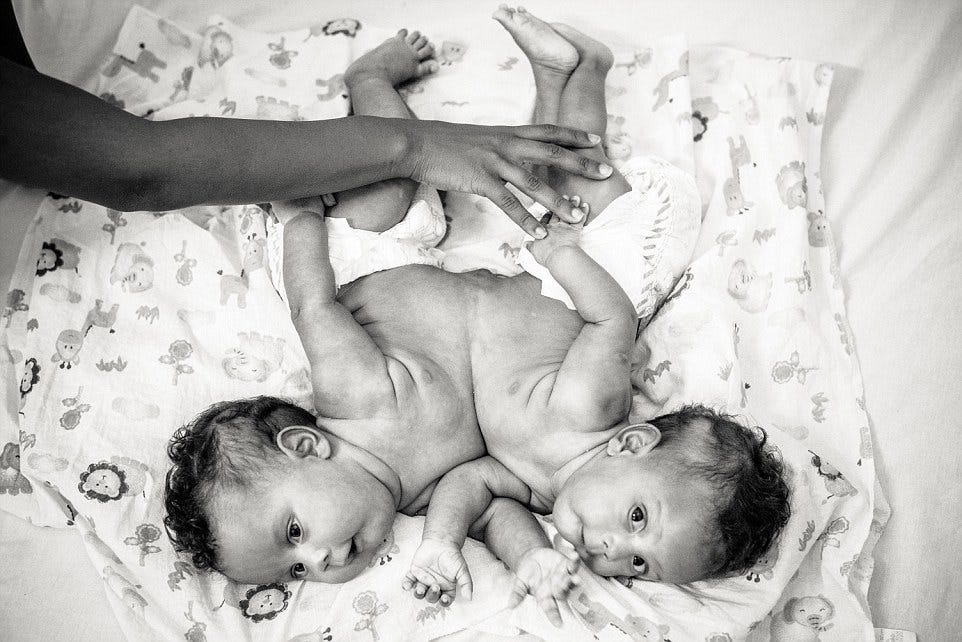 The Tragic Life Story Of The Conjoined Hilton Sisters By Sal Lessons From History Medium