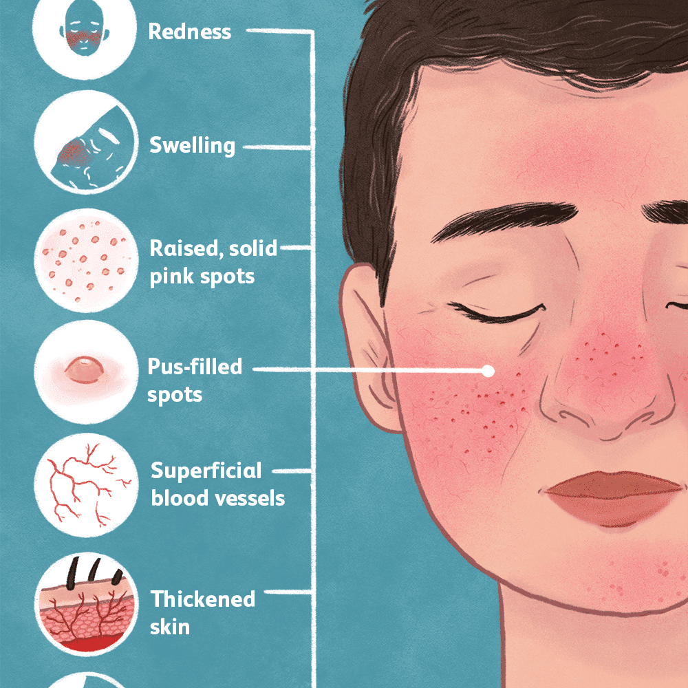 Rosacea — Know It All!. All you need to know about Rosacea. by Clipo