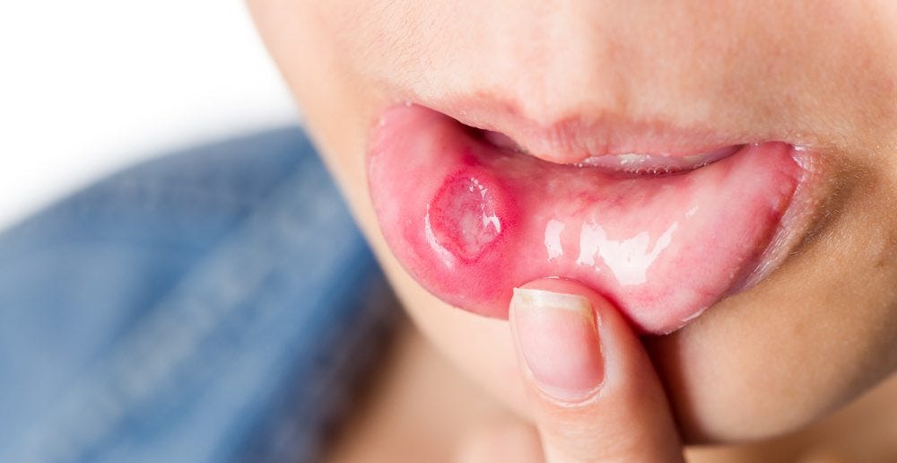 remedies for mouth ulcers