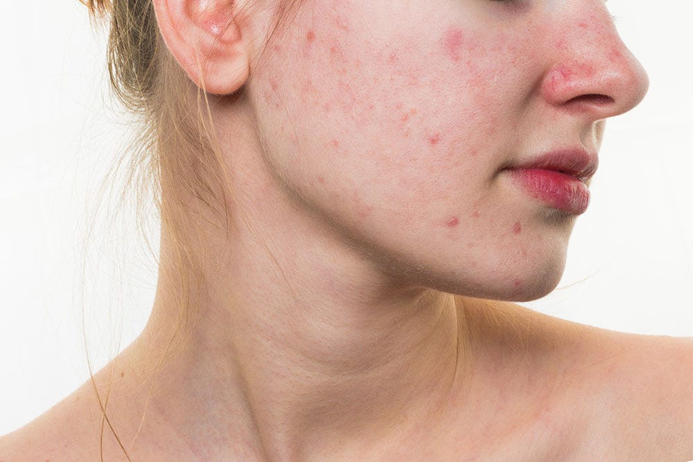 Home Remedies to get rid of Acne