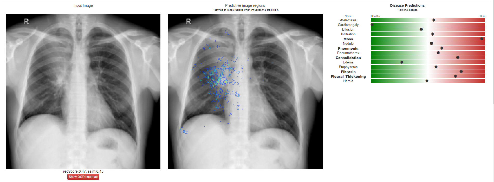 Evaluating chest xrays using AI in your browser? — testing Chester