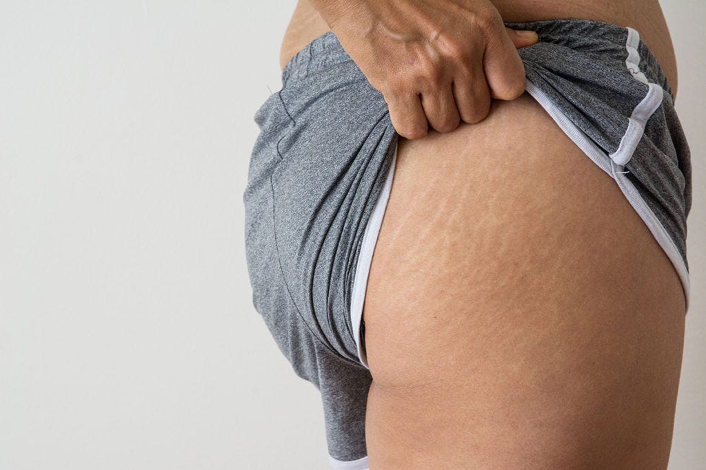 hydrocortisone stretch marks