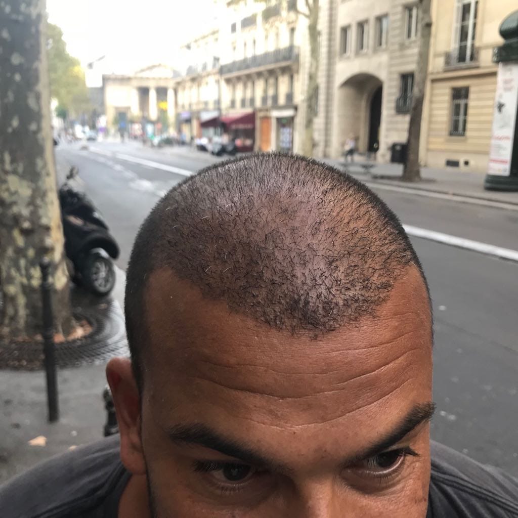 3 Months Post Op Hair Transplant Dr Arslan Dr Arslan Medium