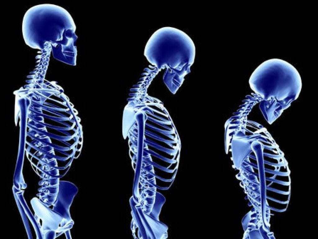 The Hard Truth About Brittle Bones by Glenn Gration Medium