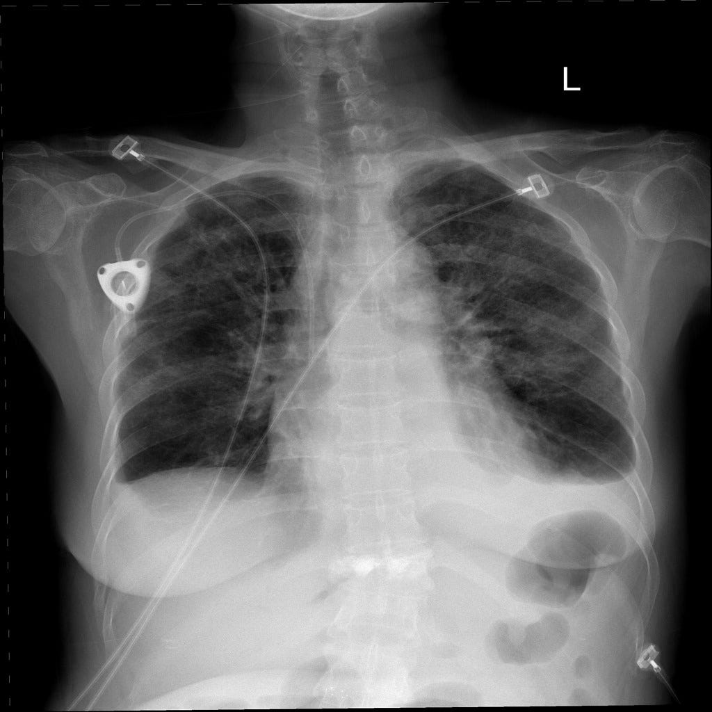 Explainable AI and COVID-19 Chest X-rays | Towards Data Science