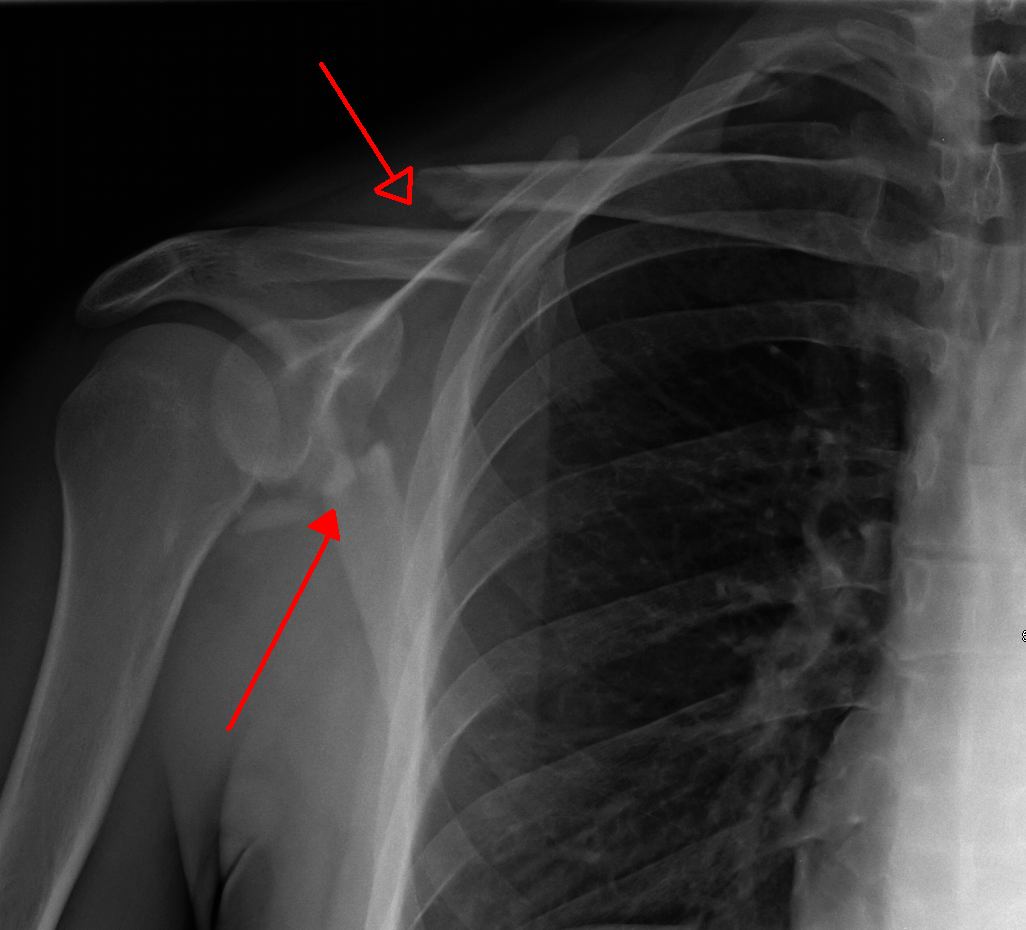 Broken Collarbone — Aftercare Health Info Medium