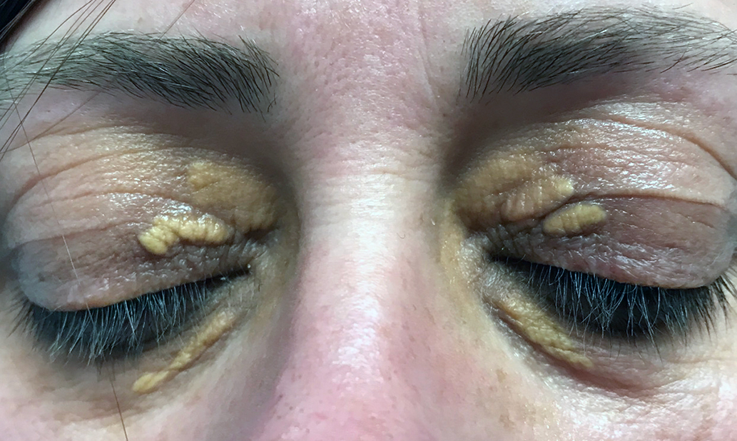 Xanthelasma — Causes And Treatments Radio Surgery At Dr Jha Clinic