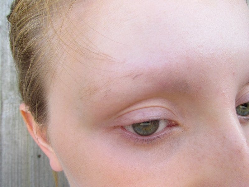 What Can Cause Eyebrow Hair Loss Healthy Stylish Medium