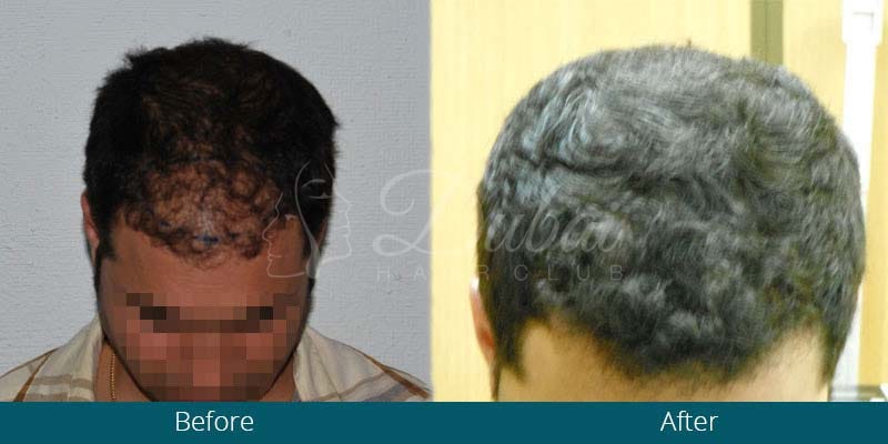 What Do You Know About Female Hair Transplant Basimah Briana