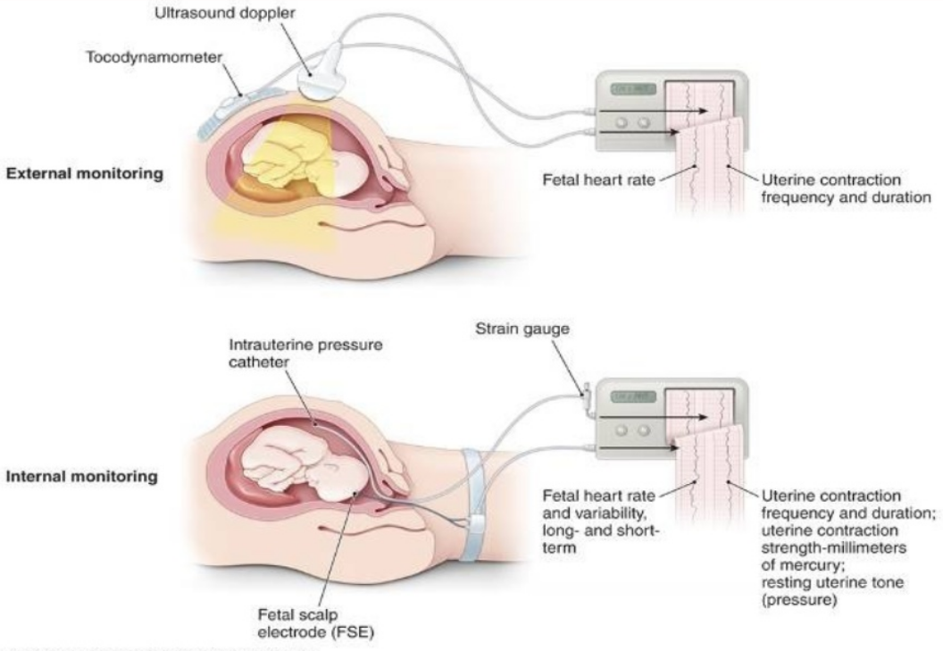 internal fetal heart monitor