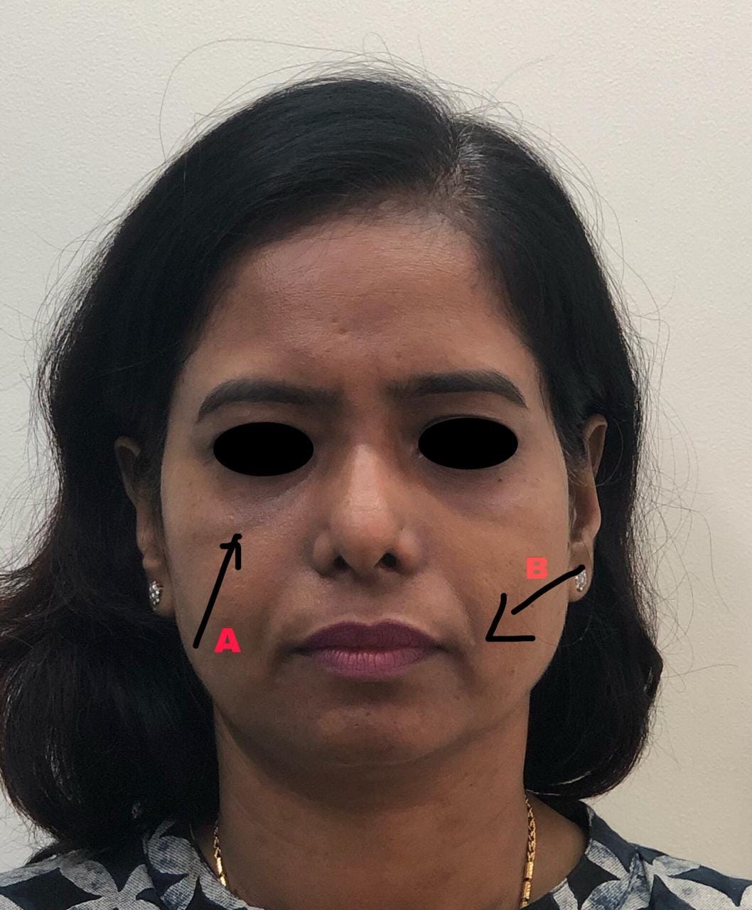 Malar Festoon And Smile Lines Dr Malay Mehta Medium