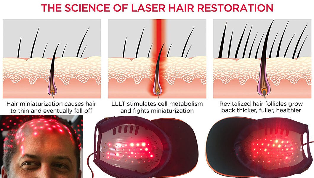 Putting A Stop To Hair Loss Lasercap Rehair Medium
