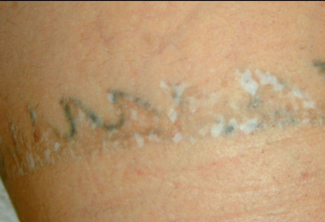 All You Need To Know About Tattoo Removal Sia Jones Medium