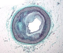 Micrograph of an artery that supplies the heart showing significant atherosclerosis and marked narrowing.