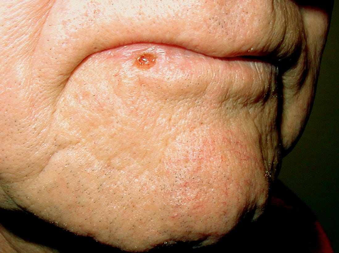 Squamous Cell Carcinoma