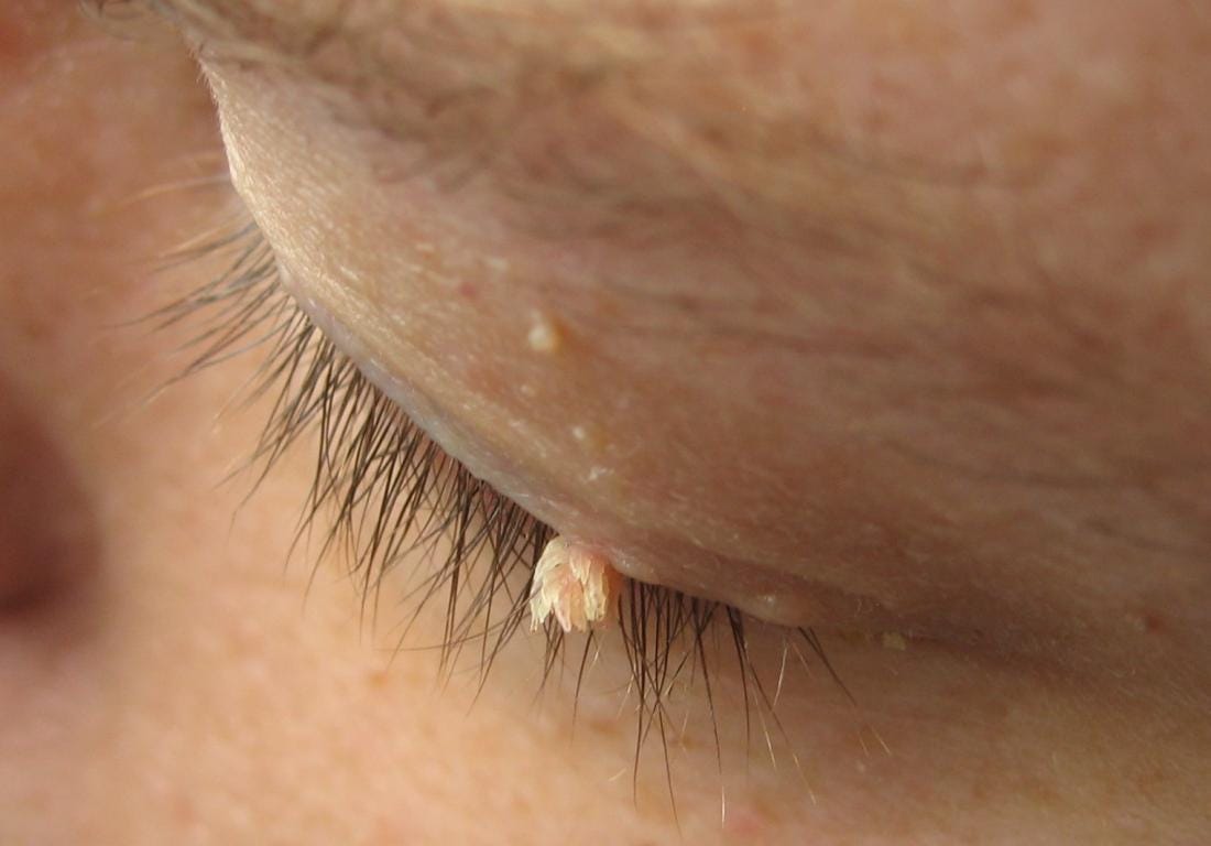 Warts Hpv Std What Kent Kayak Medium