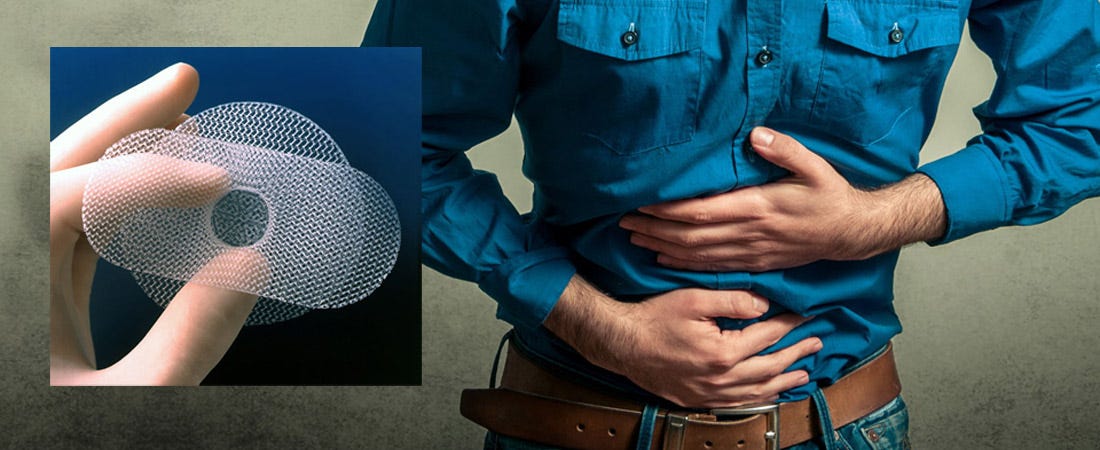 A Thorough Guide To Hernia Mesh Complications By Steven Amend Medium