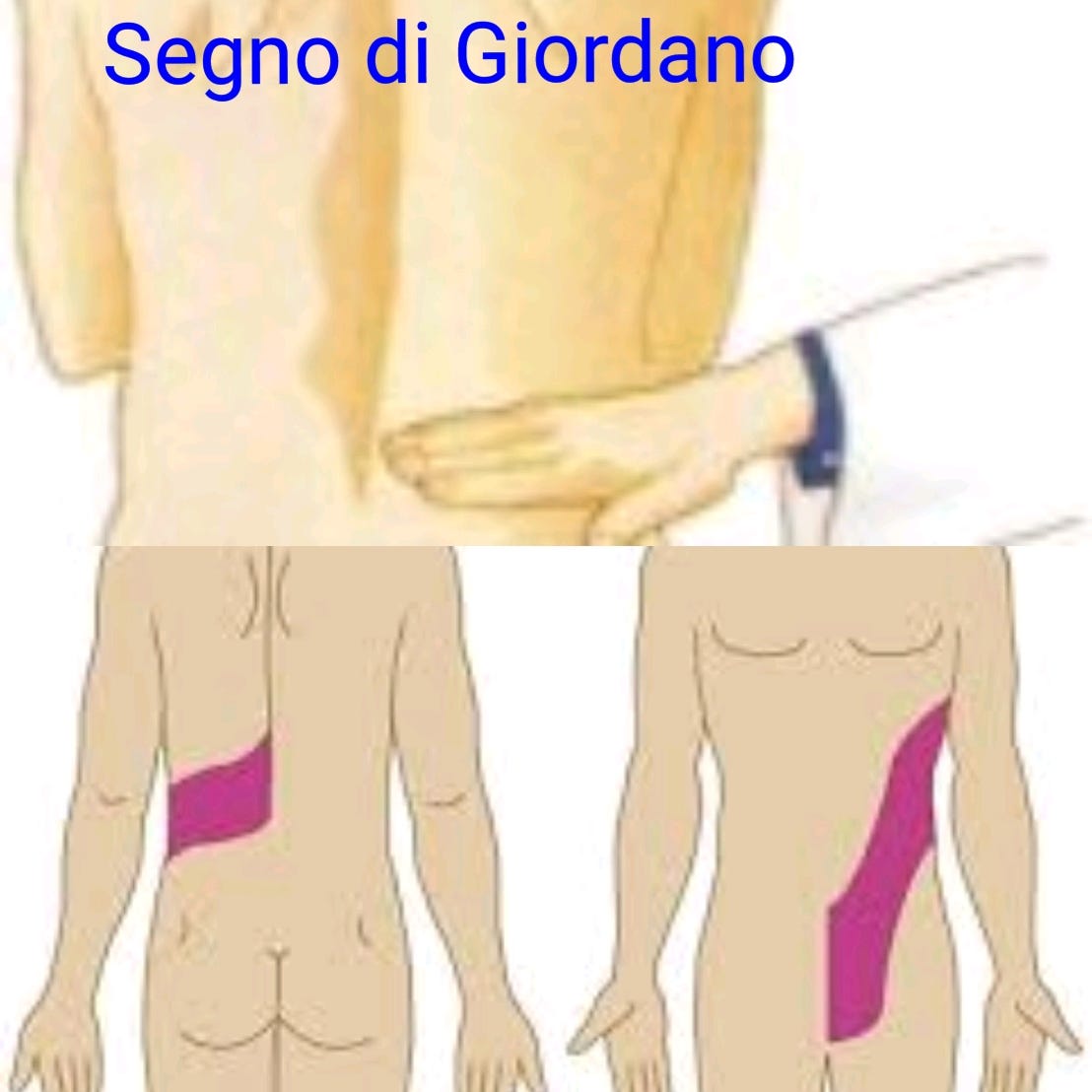 Gonalgia Idiopatica In Relazione Alla Ptosi Renale Dott