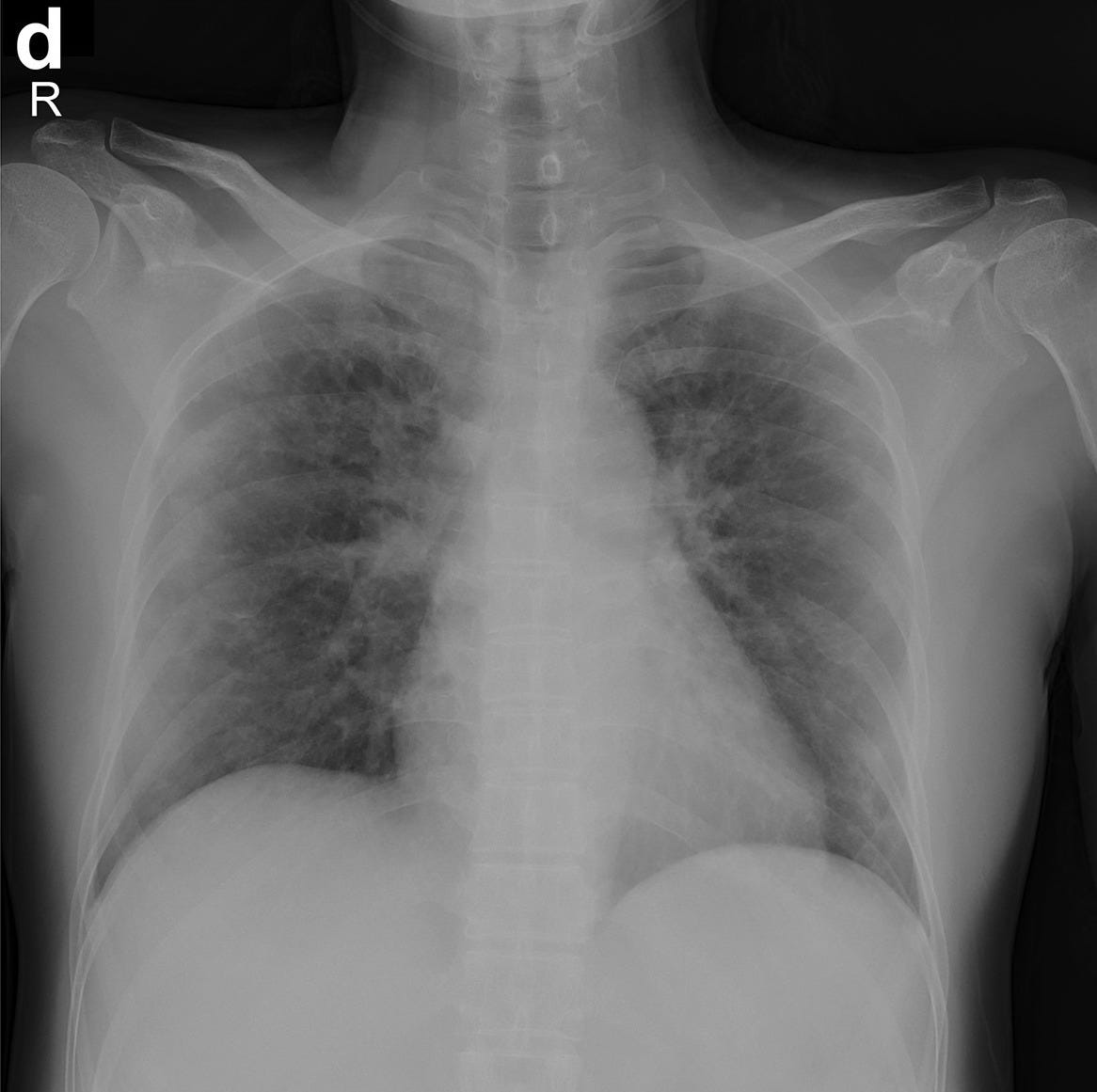 COVID19 Diagnosis System Anish Viswanathan Medium