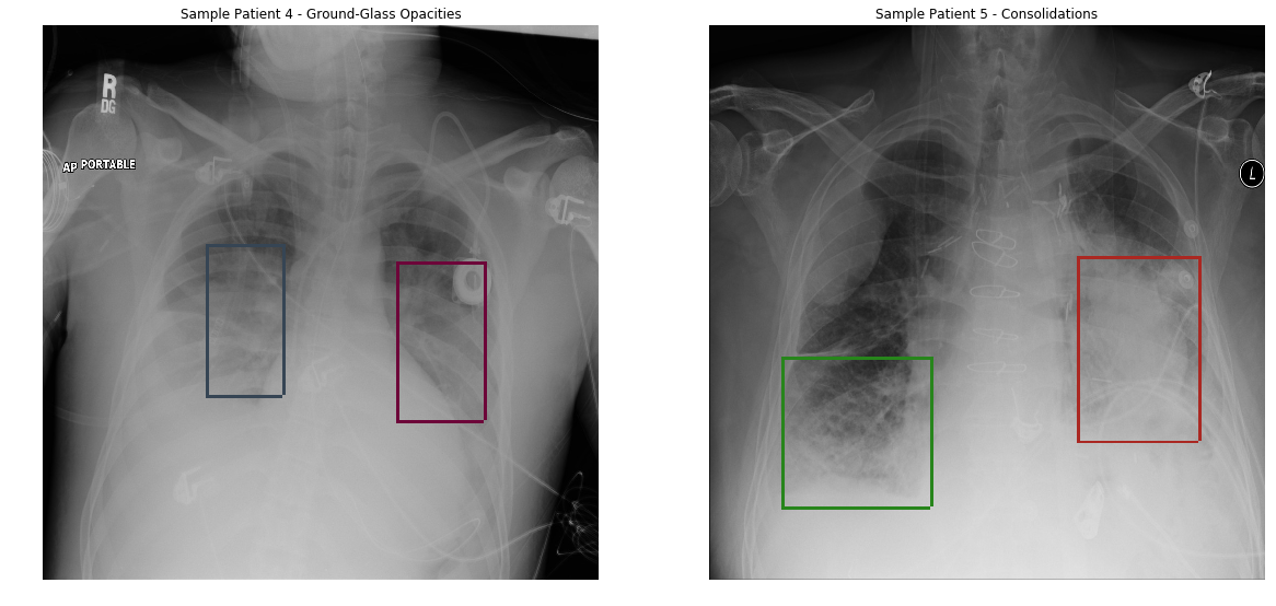 Pneumonia detection from chest radiograph using deep learning by