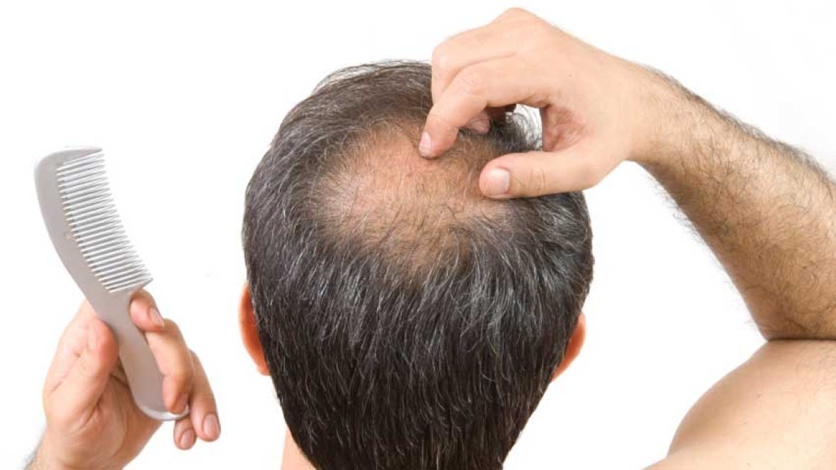 Male Pattern Baldness Hair Loss Hair Regrowth Advanced Hair