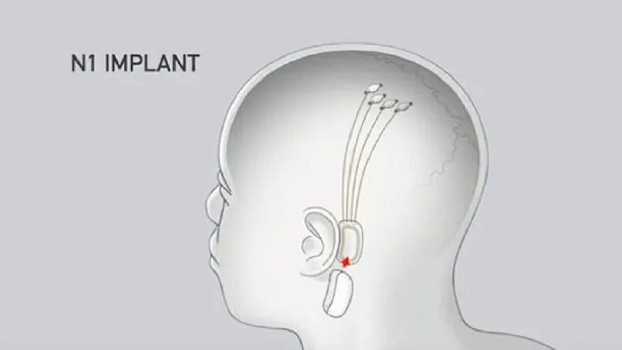 Neuralink Implant-Nadav Gover