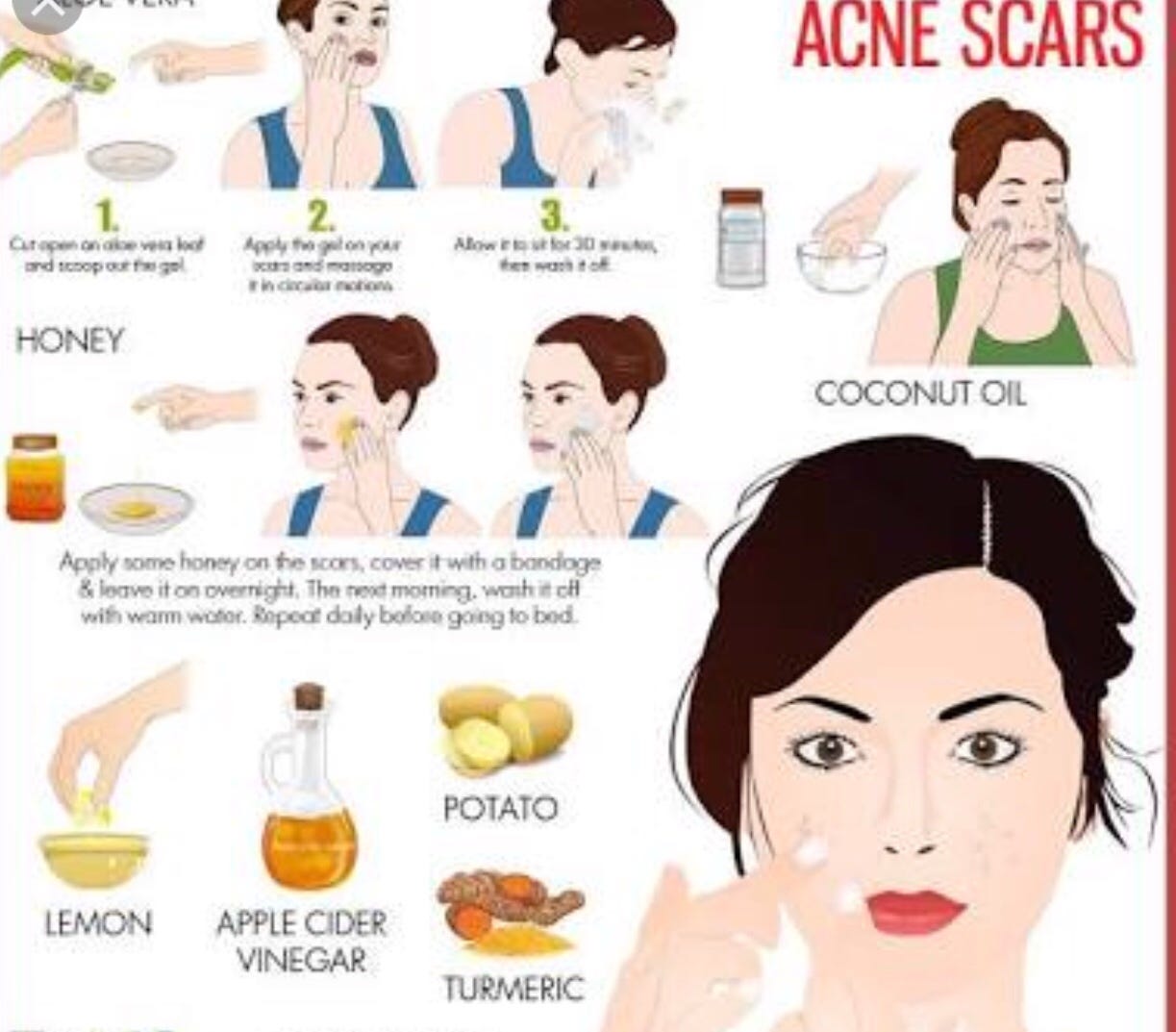 aloe per acne