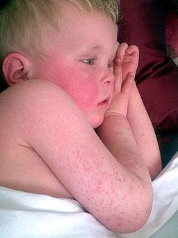 The Heartbreaking Childhood Plagues of the 1700s and 1800s | by Glenn Fay, Jr. | Medium The Heartbreaking Childhood Plagues of the 1700s and 1800s | by Glenn Fay, Jr. | Medium