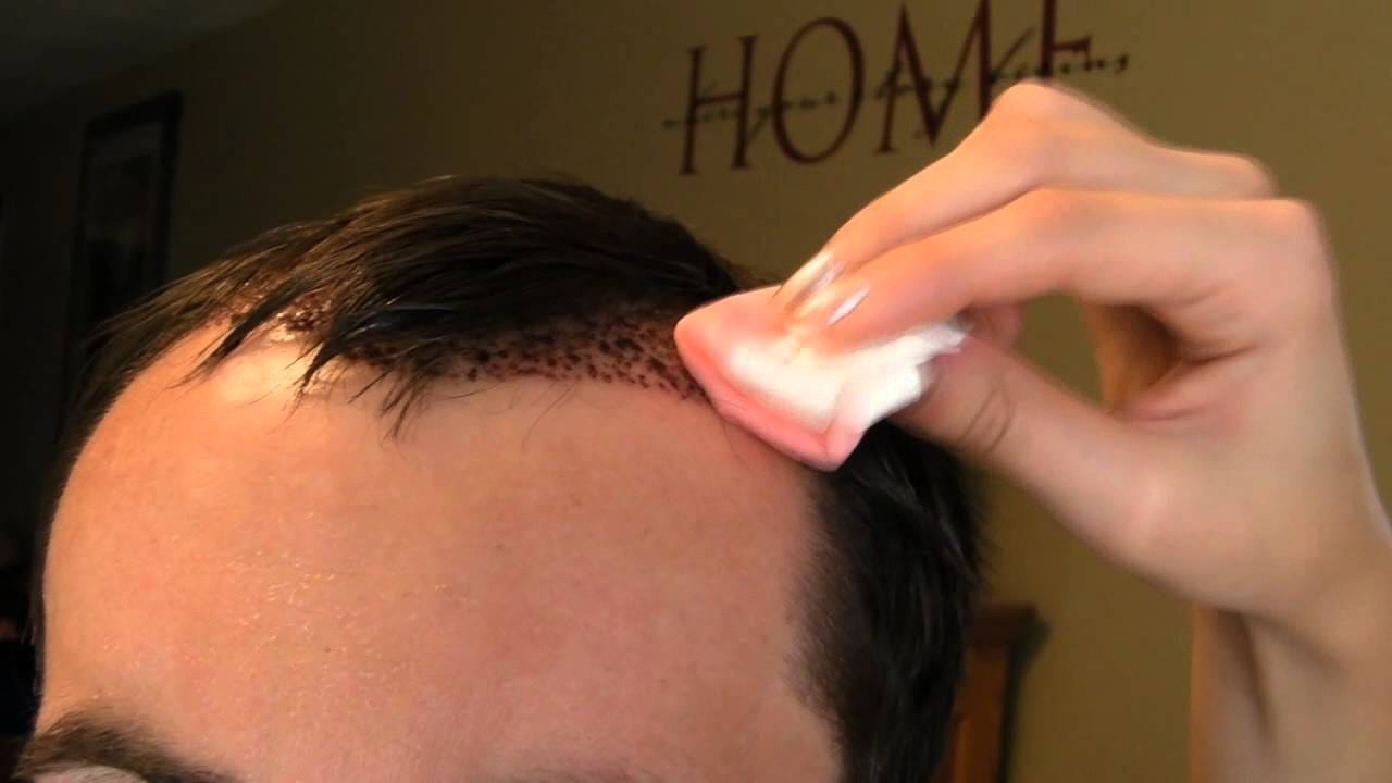 About Post Hair Transplant Care Gokhan Duman Medium
