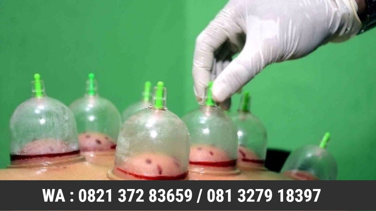Bekam Asam Urat Di Banjarnegara 082137283659 By Griya Lebah Emas Medium Bekam Asam Urat Di Banjarnegara 082137283659 By Griya Lebah Emas Medium