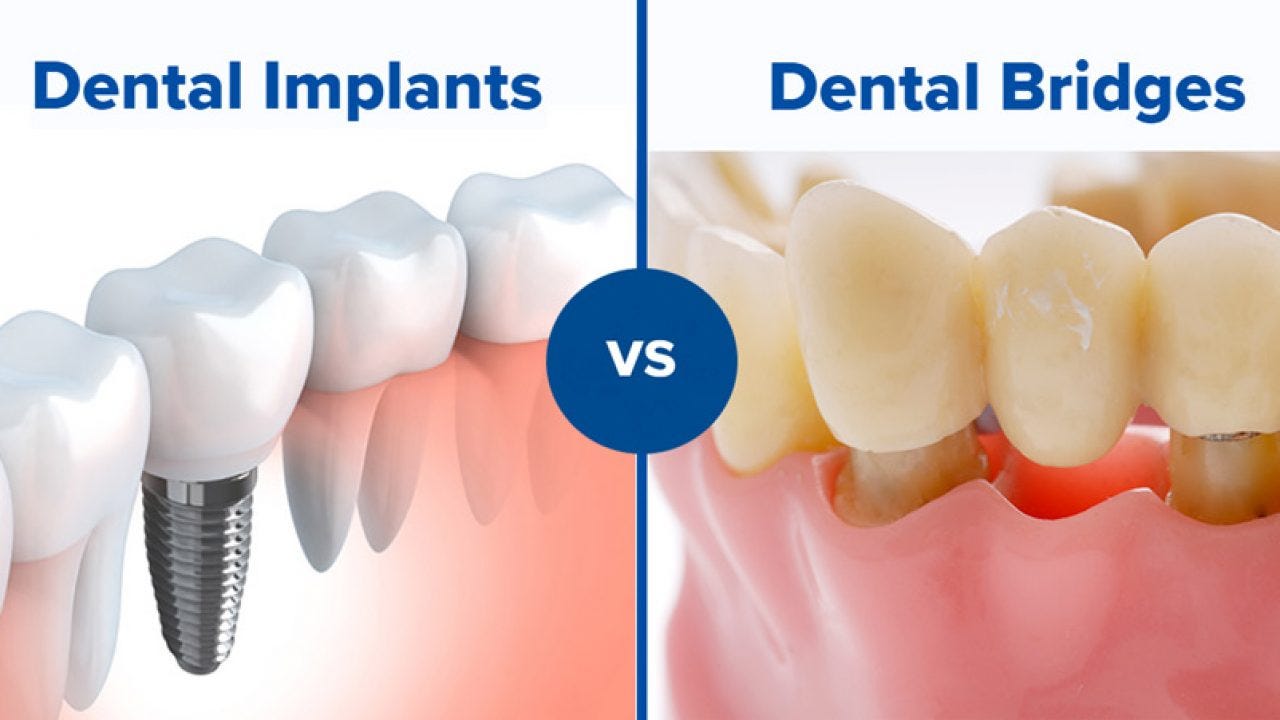 Dental Implant or Bridge Which is Better Bridge vs Implant Pros Cons