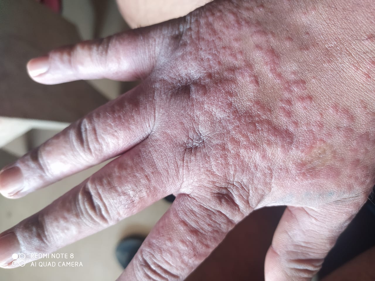 Hand Irritation Rashes How To Wash Your Hands By Mansi Saxena Medium