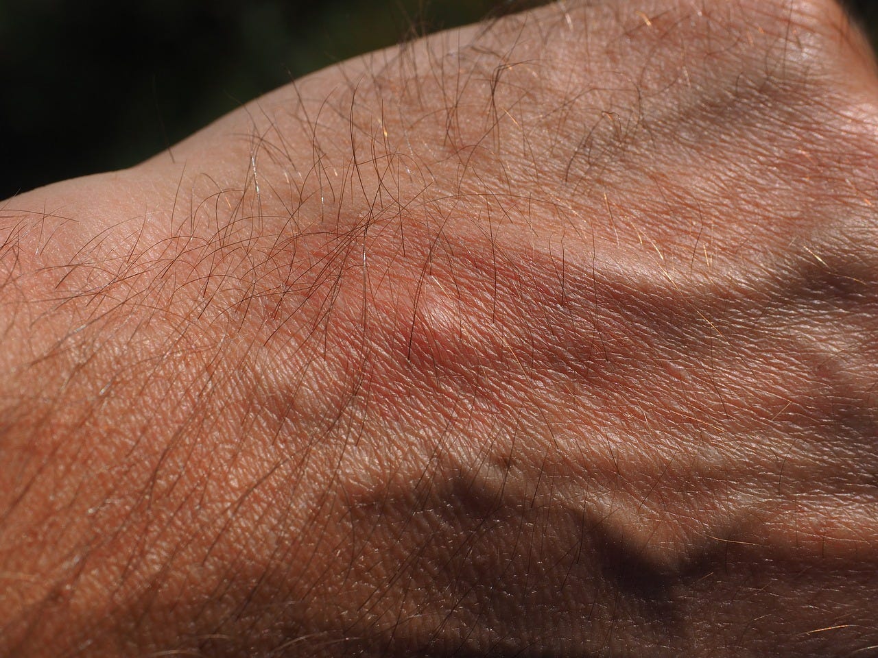 Can Spiders Actually Lay Eggs Under Human Skin Rehnwriter Medium