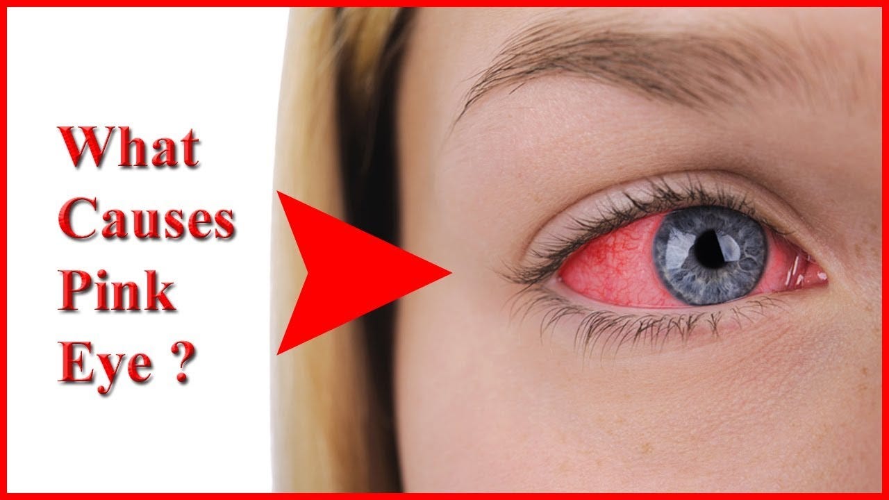 4 Major Pink Eye Causes (Eye Conjunctivitis) | by Ayurveda Editor | Medium