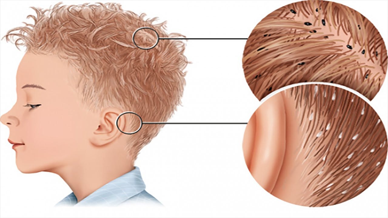 10 Natural Home Remedies To Get Rid Of Head Lice Iris Mauro